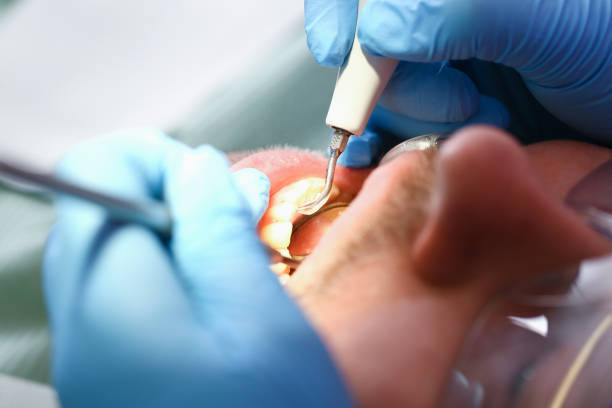 Best Emergency Dental Care for Broken or Chipped Teeth in South Milwaukee, WI